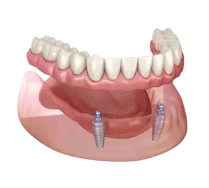 Dental Implants all on 2